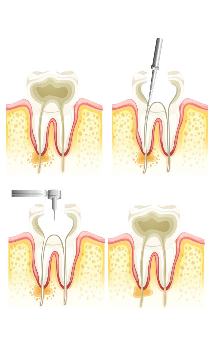 Root Canal Therapy Ocean Dental Burnaby